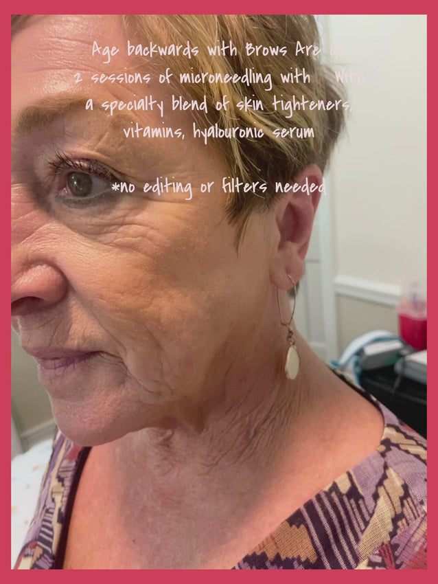 Baby Botox Units - Microneedling Session | NCBodyMetrics